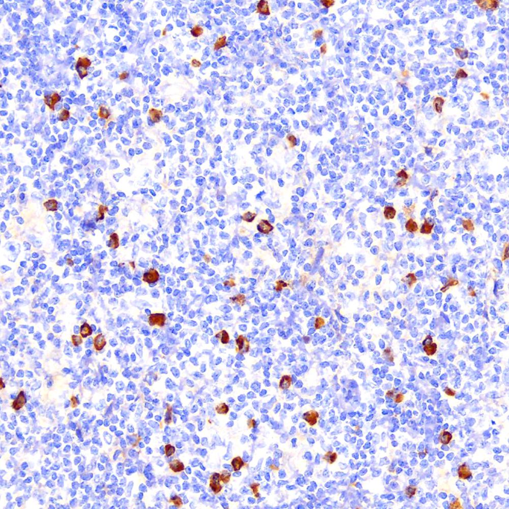 Lambda light chain - MCGP