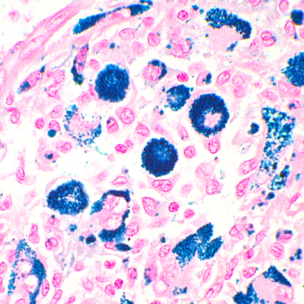 Perls Staining Perls Stain satined on Giant cell tumour of tendon sheath