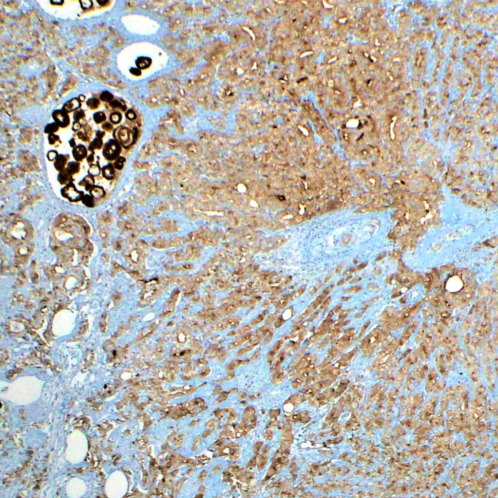 Prostate ca stained with Anti-PSA