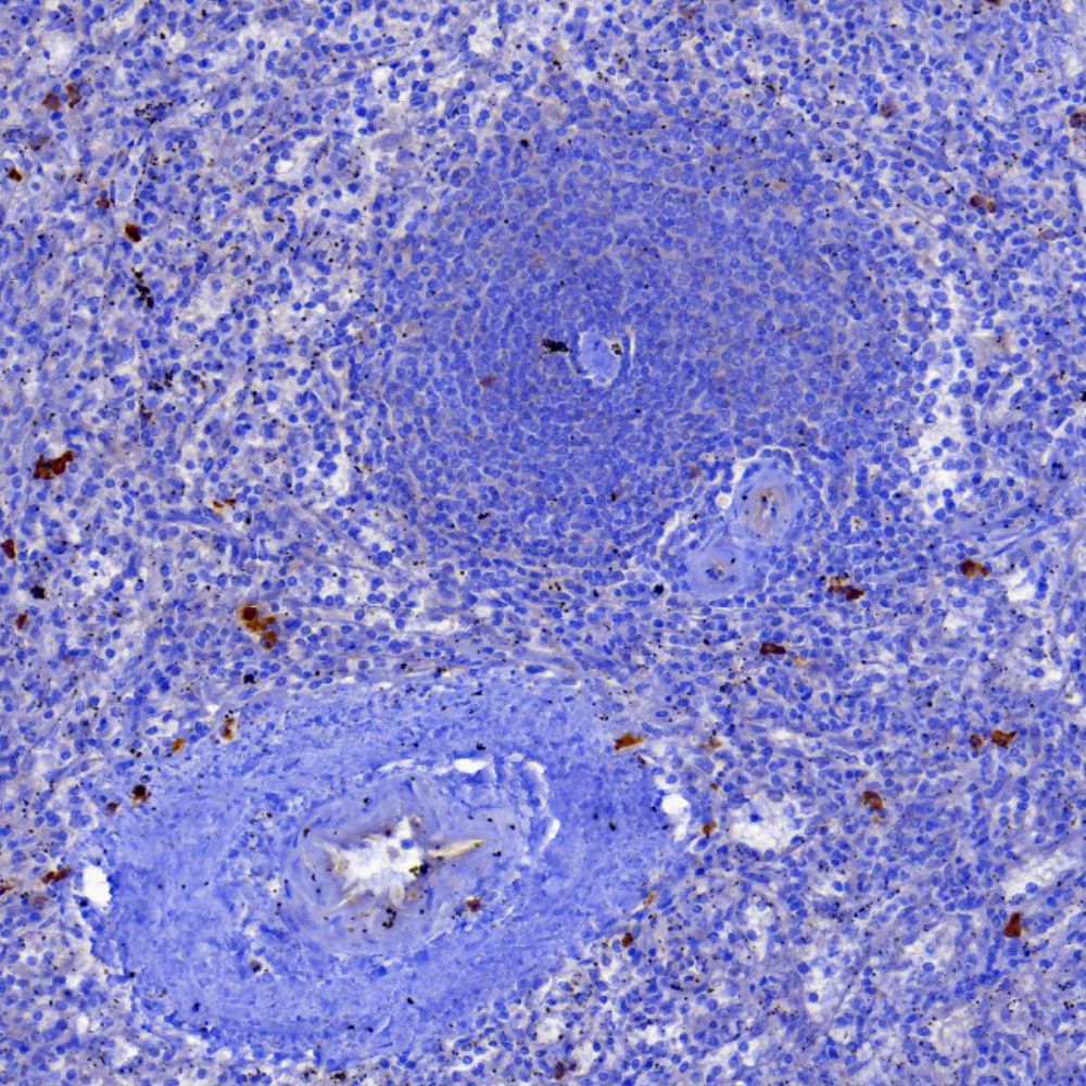 Lambda light chain - MCGP